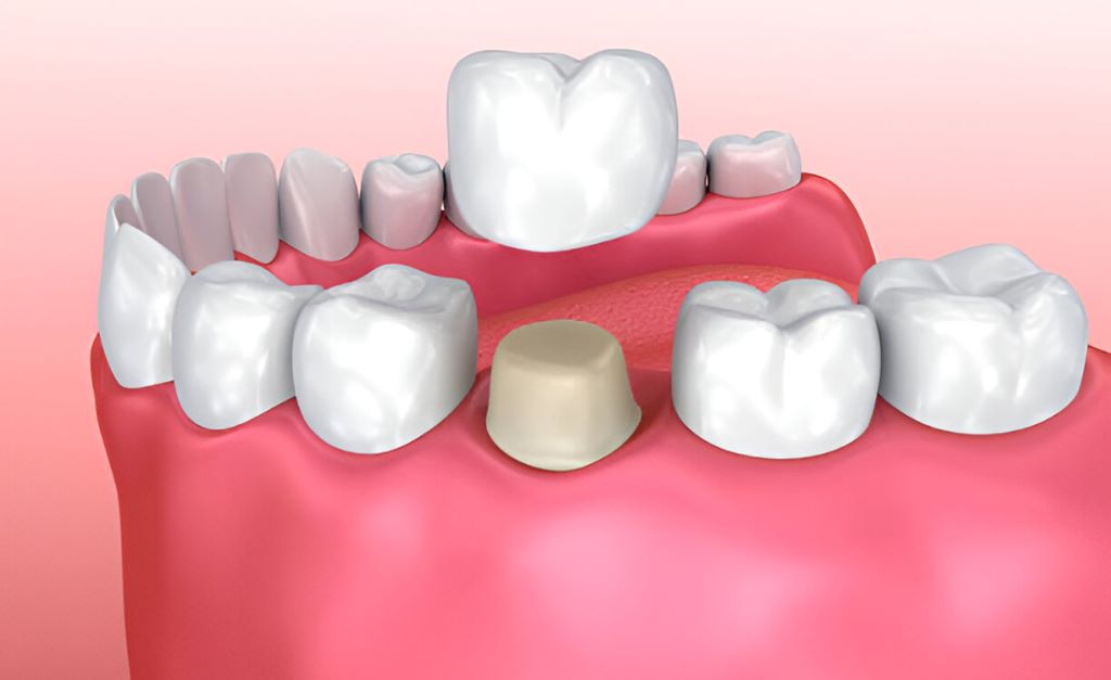 dental crowns toledo