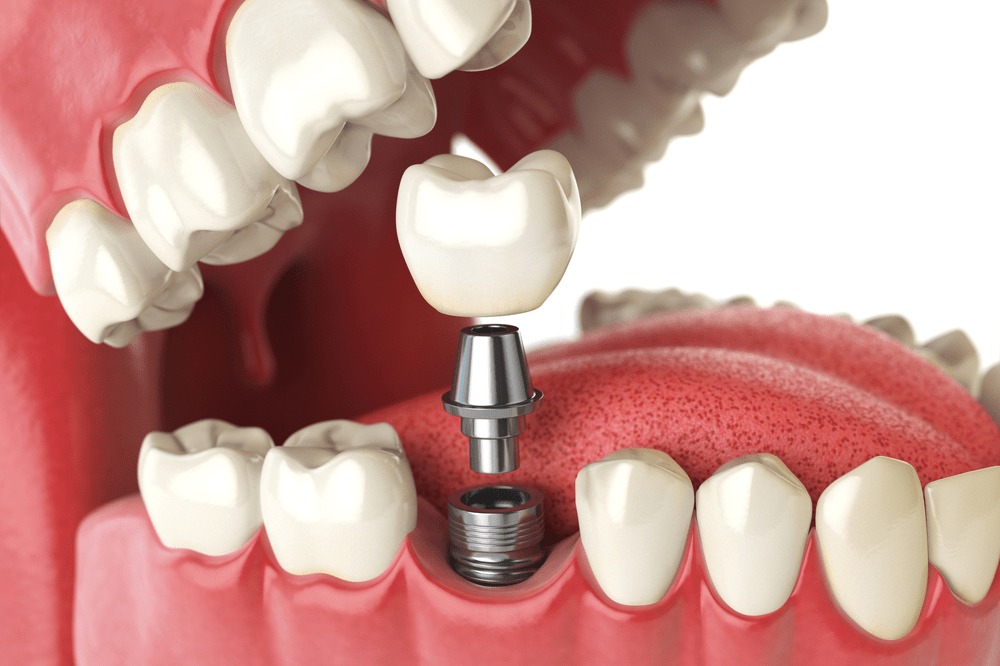 Can Dental Implants Help Prevent Bone Loss in Your Jaw