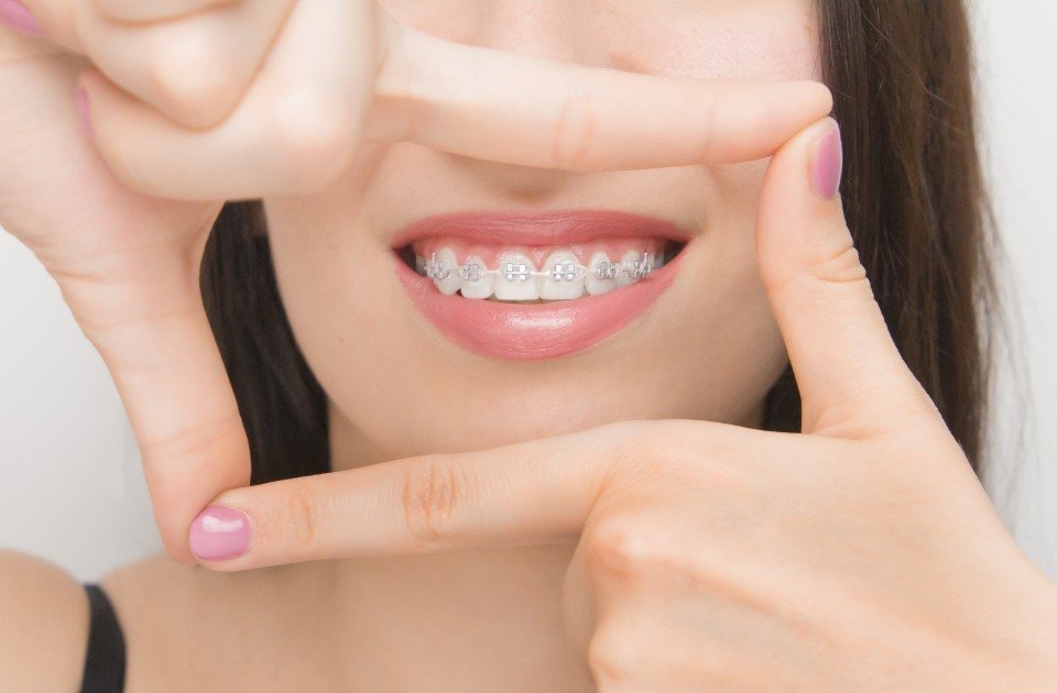 Braces in Toledo