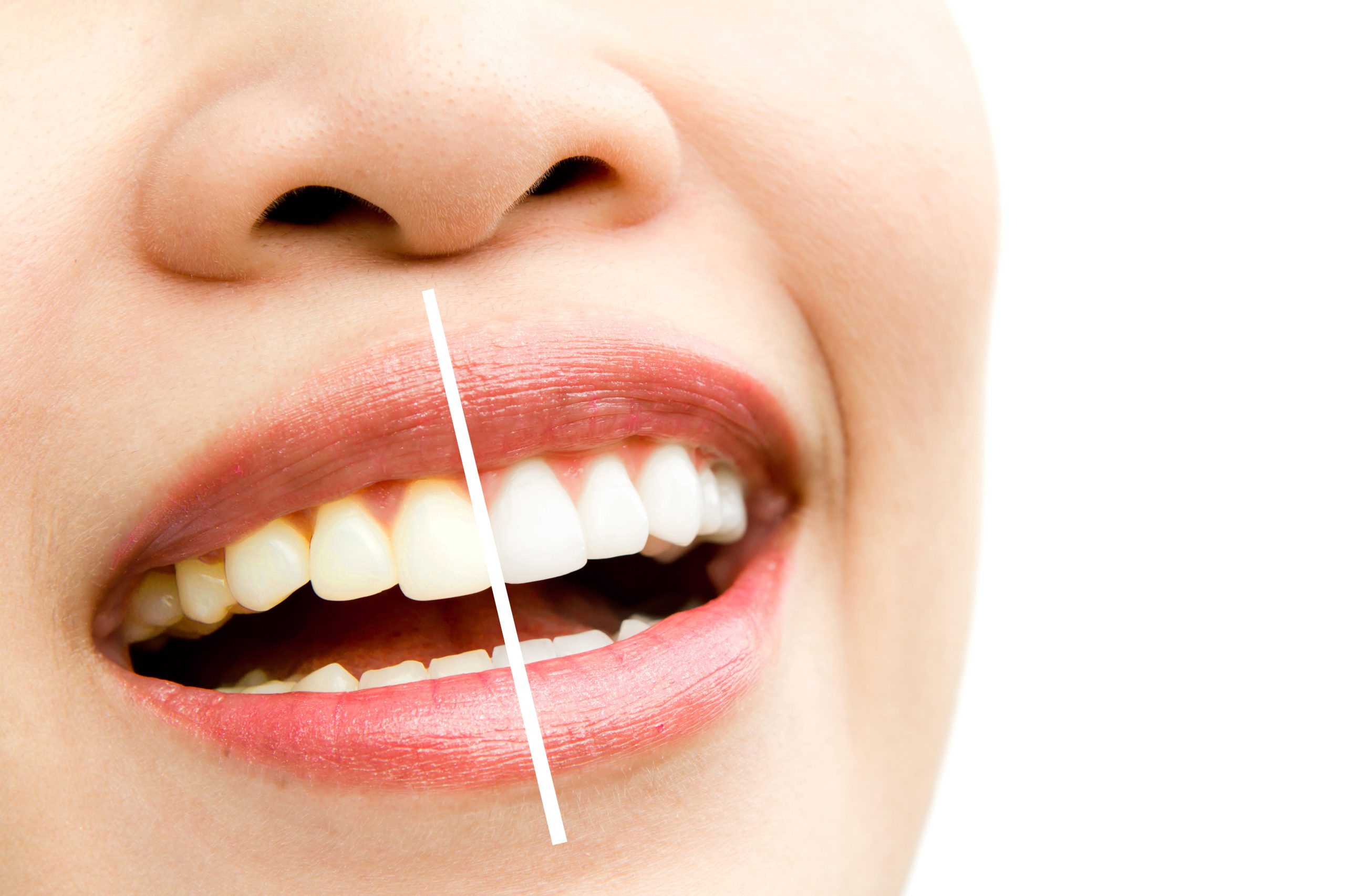 what Is professional teeth whitening? better option: professional teeth whitening or at-home kits